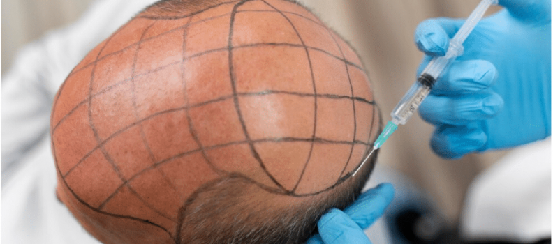 Hair Transplantation for Crown Baldness