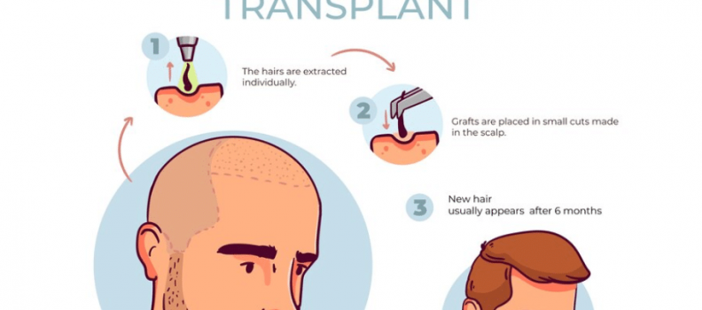 How To Start a Hair Transplant Business or Clinic