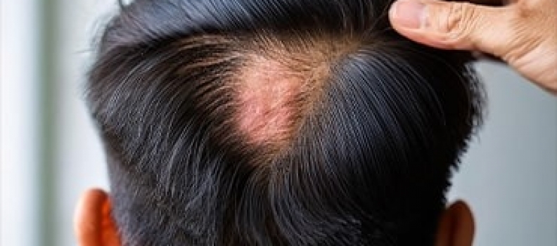 What is Alopecia Areata Treatment?